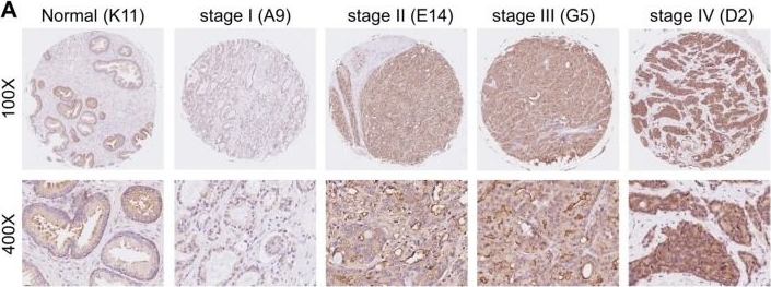Fig.1.A showing Immunohistochemistry in a Homo sapiens (Human) sample from the publication: Phosphoribosyl pyrophosphate synthetases 2 knockdown inhibits prostate cancer progression by suppressing cell cycle and inducing cell apoptosis.