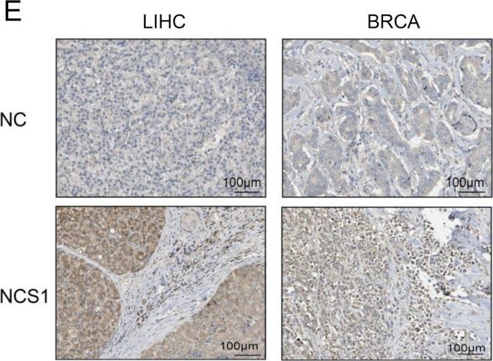 Fig.1.E showing Immunohistochemistry in a Homo sapiens (Human) sample from the publication: The Role of NCS1 in Immunotherapy and Prognosis of Human Cancer.