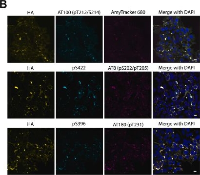 Fig.3.B showing Immunocytochemistry-immunofluorescence in a Homo sapiens (Human) sample from the publication: Sensitive detection and propagation of brain-derived tau assemblies in HEK293-based wild-type tau seeding assays.