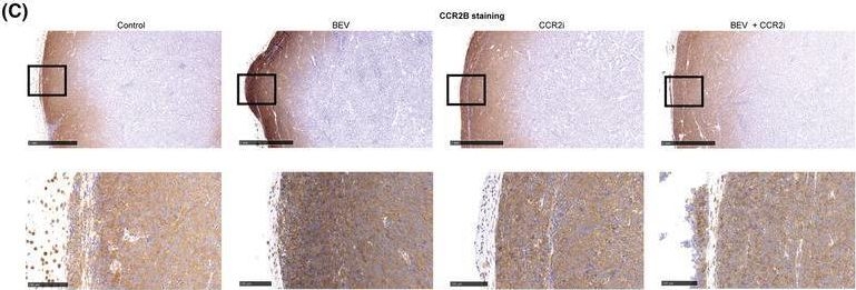 Fig.2.C showing Immunohistochemistry from the publication: Combination therapy with bevacizumab and a CCR2 inhibitor for human ovarian cancer: An in vivo validation study.