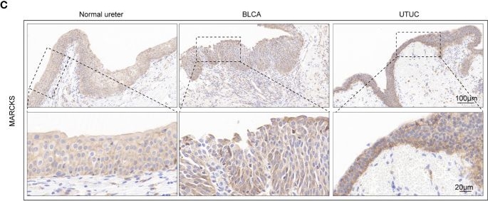 Fig.11.C showing Immunohistochemistry in a Homo sapiens (Human) sample from the publication: Investigating cellular similarities and differences between upper tract urothelial carcinoma and bladder urothelial carcinoma using single-cell sequencing.