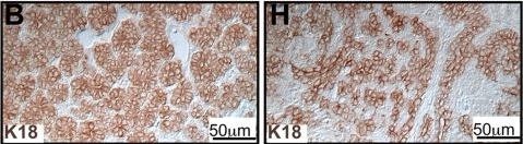 MMTV-Wnt1 and -DeltaN89beta-catenin induce canonical signaling in distinct progenitors and differentially activate Hedgehog signaling within mammary tumors.