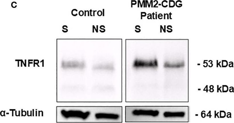 Fig.1.C showing Western Blotting from the publication: Immunopathology in PMM2-CDG: Defective glycosylation impact in the TNFα -TNFR1 signalling pathway.