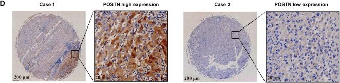 Fig.4.D showing Immunohistochemistry in a Homo sapiens (Human) sample from the publication: A postoperative recurrence prediction model for intrahepatic cholangiocarcinoma based on multi-omics analysis of adjacent-to-tumor tissues.