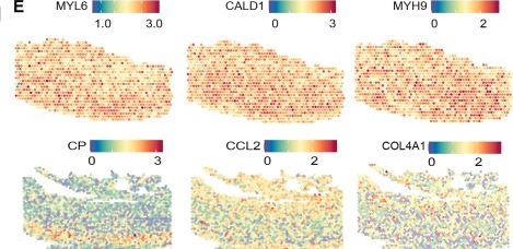 Fig.3.E showing Immunohistochemistry from the publication: Spatial transcriptomic analysis reveals spatial features in human Stanford type A aortic dissection.