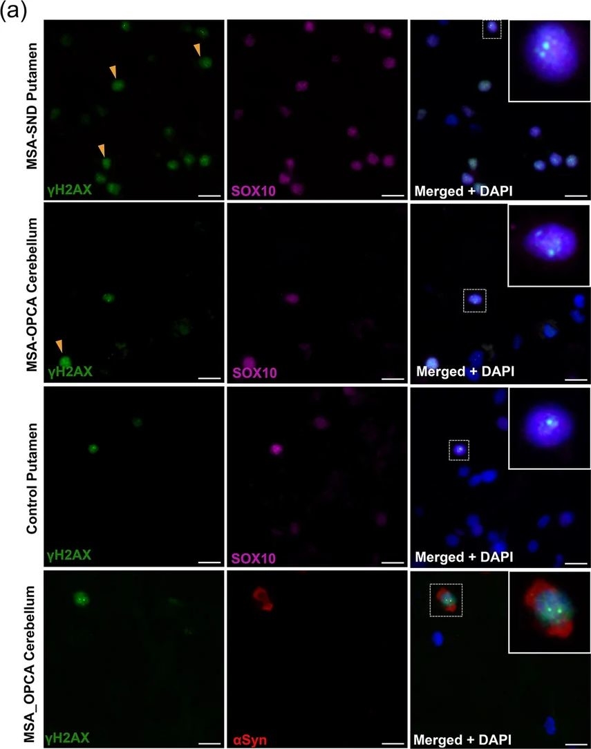 Fig.6.A showing Immunocytochemistry-immunofluorescence from the publication: Oligodendroglial somatic SNCA copy number gains are associated with inclusions and disease onset in multiple system atrophy.