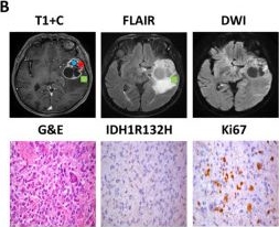 Fig.11.B showing Immunohistochemistry in a Homo sapiens (Human) sample from the publication: RAS70 peptide targets multiforme glioblastoma by binding to the plasma membrane heat shock protein HSP70.