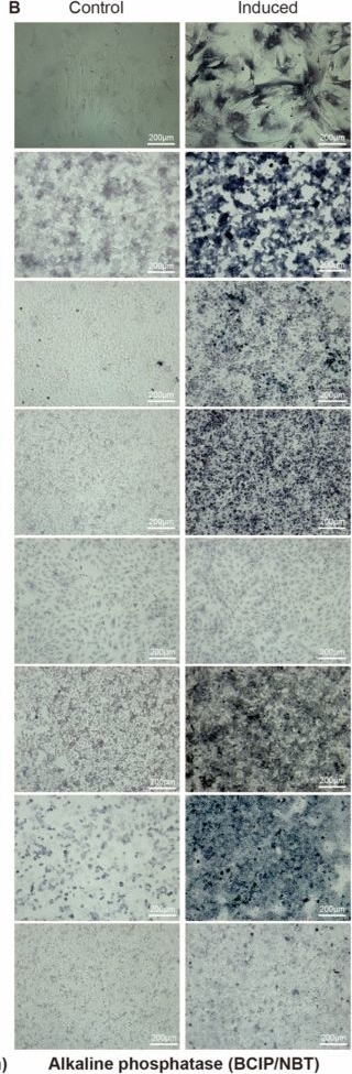 Fig.1.B showing Immunohistochemistry in a Homo sapiens (Human) sample from the publication: Osteogenic-like Phenotypic Reprogramming Is Associated with Reduced Malignant Behaviors in Pancreatic Cancer Cells Involving MAPK-ERK Signaling.