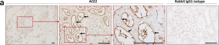 Fig.3.A showing Immunohistochemistry in a SARS-CoV-2 sample from the publication: Human kidney is a target for novel severe acute respiratory syndrome coronavirus 2 infection.