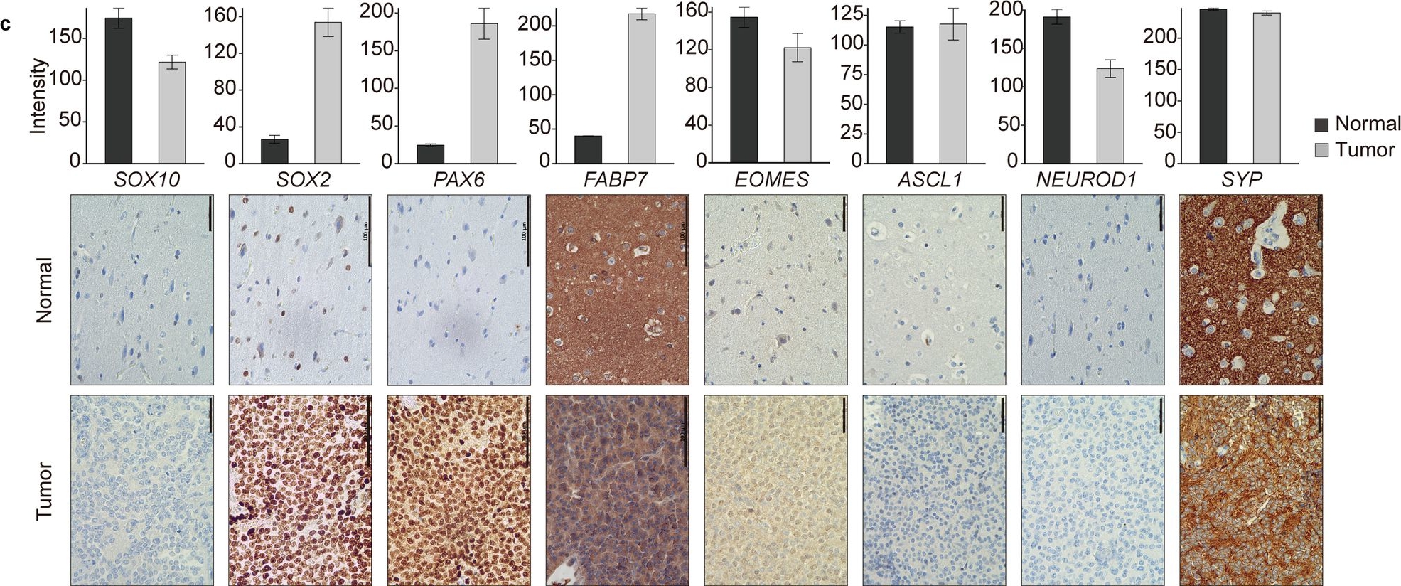 Fig.2.C showing Immunohistochemistry in a Homo sapiens (Human) sample from the publication: Central neurocytoma exhibits radial glial cell signatures with FGFR3 hypomethylation and overexpression.