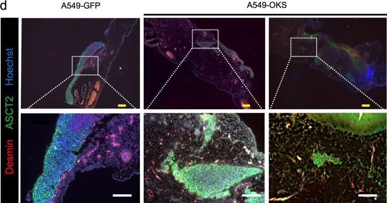 Fig.2.D showing Immunohistochemistry-immunofluorescence in a Homo sapiens (Human) sample from the publication: Chorioallantoic membrane assay revealed the role of TIPARP (2,3,7,8-tetrachlorodibenzo-p-dioxin-inducible poly (ADP-ribose) polymerase) in lung adenocarcinoma-induced angiogenesis.
