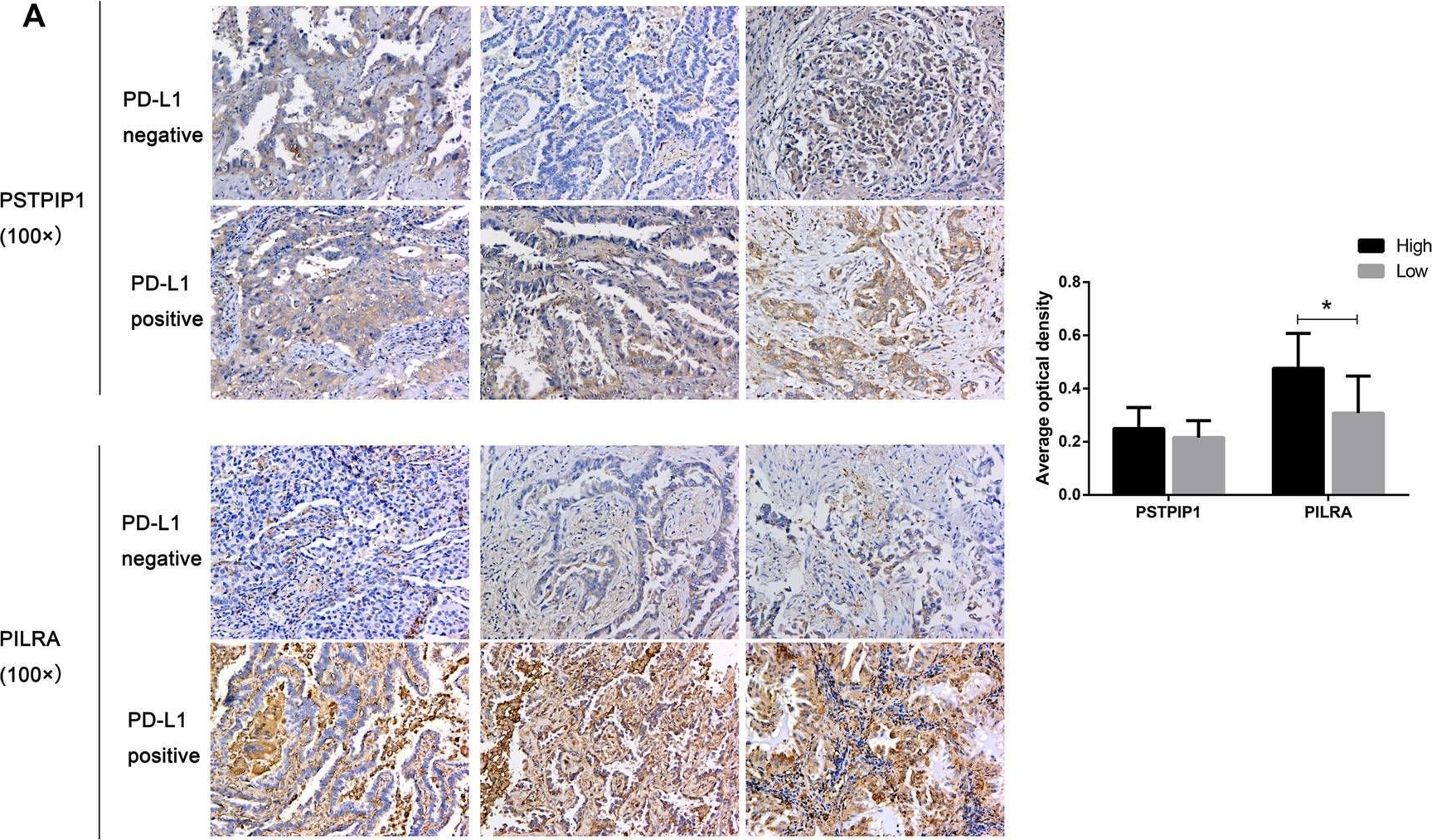 Fig.6.A showing Immunohistochemistry from the publication: Identification of Novel Prognostic Biomarkers Relevant to Immune Infiltration in Lung Adenocarcinoma.