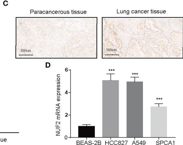 Fig.2.C showing Immunohistochemistry from the publication: NUF2 Expression Promotes Lung Adenocarcinoma Progression and Is Associated With Poor Prognosis.