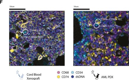 Fig.5.F showing Immunohistochemistry-immunofluorescence in a Homo sapiens (Human) sample from the publication: Identification of cells of leukemic stem cell origin with non-canonical regenerative properties.