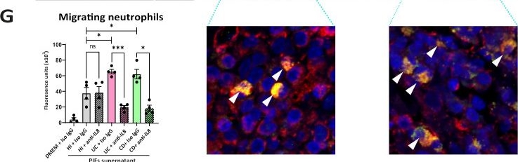Fig.2.G showing Immunohistochemistry-immunofluorescence in a Homo sapiens (Human) sample from the publication: Neutrophil-fibroblast crosstalk drives immunofibrosis in Crohn's disease through IFNα pathway.