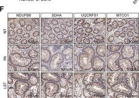 Fig.3.F showing Immunohistochemistry in a Homo sapiens (Human) sample from the publication: A Soft Matrix Microenvironment Promotes Laterally Spreading Tumors via Oxidative Phosphorylation-Dependent Cell Adhesion.