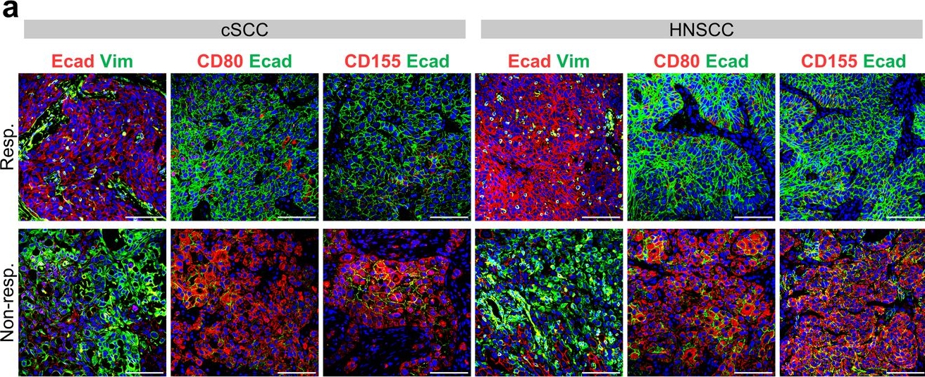 Fig.7.A showing Immunohistochemistry-immunofluorescence in a Homo sapiens (Human) sample from the publication: Cancer cell plasticity defines response to immunotherapy in cutaneous squamous cell carcinoma.