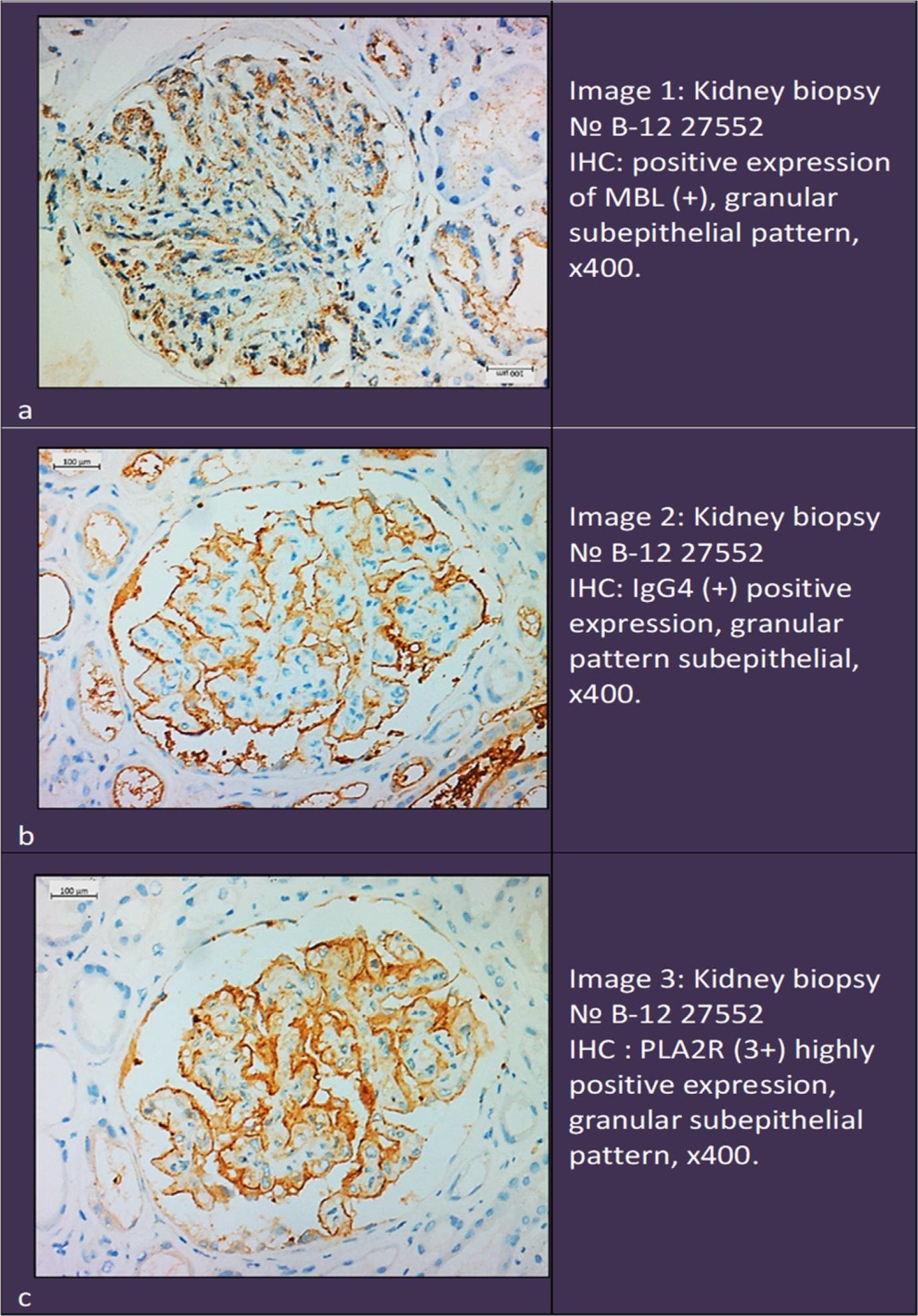 Fig.2.A showing Immunohistochemistry from the publication: Mannose-Binding Lectin Deposition in Membranous Nephropathy and Differentiation of Primary from Secondary Forms.
