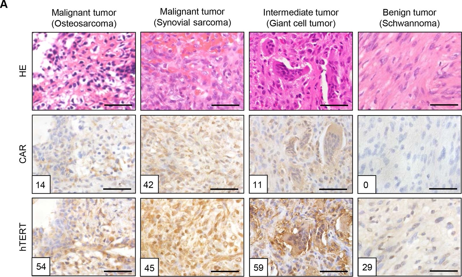 Fig.3.A showing Immunohistochemistry in a Homo sapiens (Human) sample from the publication: Fluorescence-guided assessment of bone and soft-tissue sarcomas for predicting the efficacy of telomerase-specific oncolytic adenovirus.