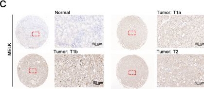 Fig.6.C showing Immunohistochemistry from the publication: Integrated analysis of the roles of oxidative stress related genes and prognostic value in clear cell renal cell carcinoma.
