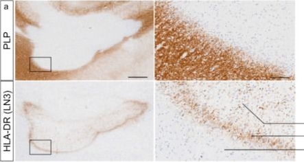 Fig.6.A showing Immunohistochemistry in a Homo sapiens (Human) sample from the publication: Loss of oligodendrocyte transcription factor 2 protein expression in metabolically stressed oligodendrocytes.