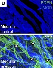 Fig.4.D showing Immunohistochemistry-immunofluorescence from the publication: Organ-specific features of human kidney lymphatics are disrupted in chronic transplant rejection.