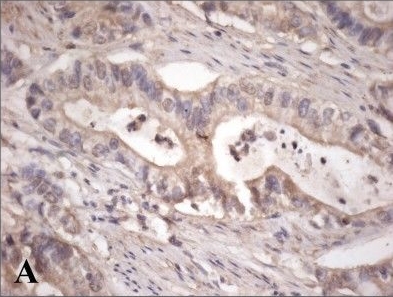 Expression of plakophilins (PKP1, PKP2, and PKP3) in gastric cancers.