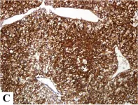 Fig.1.C showing Immunohistochemistry in a Homo sapiens (Human) sample from the publication: Expression of hypoxic marker carbonic anhydrase IX predicts poor prognosis in resectable hepatocellular carcinoma.