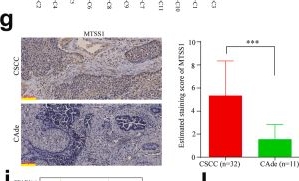 Fig.5.G showing Immunohistochemistry in a Homo sapiens (Human) sample from the publication: Single-nucleus RNA sequencing reveals heterogenous microenvironments and specific drug response between cervical squamous cell carcinoma and adenocarcinoma.