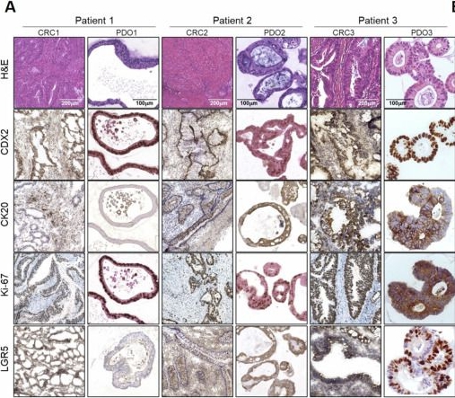 Fig.2.A showing Immunohistochemistry in a Homo sapiens (Human) sample from the publication: Colorectal cancer patients-derived immunity-organoid platform unveils cancer-specific tissue markers associated with immunotherapy resistance.