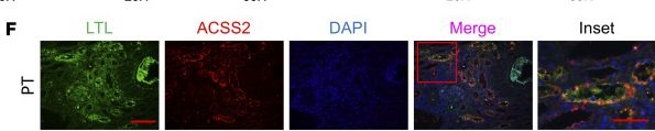 Fig.7.F showing Immunohistochemistry-immunofluorescence from the publication: ACSS2 gene variants determine kidney disease risk by controlling de novo lipogenesis in kidney tubules.