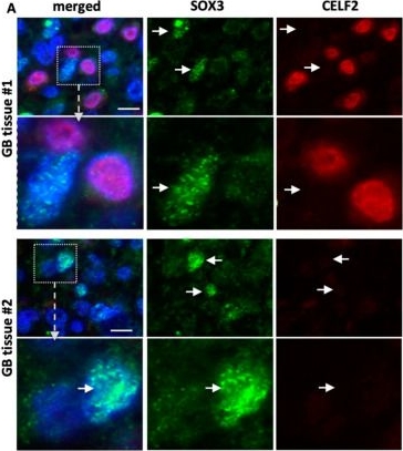 Fig.7.A showing Immunocytochemistry-immunofluorescence from the publication: CELF2 Sustains a Proliferating/OLIG2+ Glioblastoma Cell Phenotype via the Epigenetic Repression of SOX3.