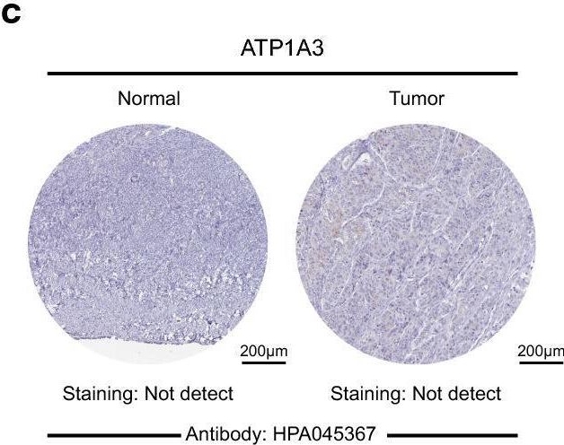 Fig.3.C showing Immunohistochemistry from the publication: Comprehensive analysis of the expression of sodium/potassium-ATPase α subunits and prognosis of ovarian serous cystadenocarcinoma.