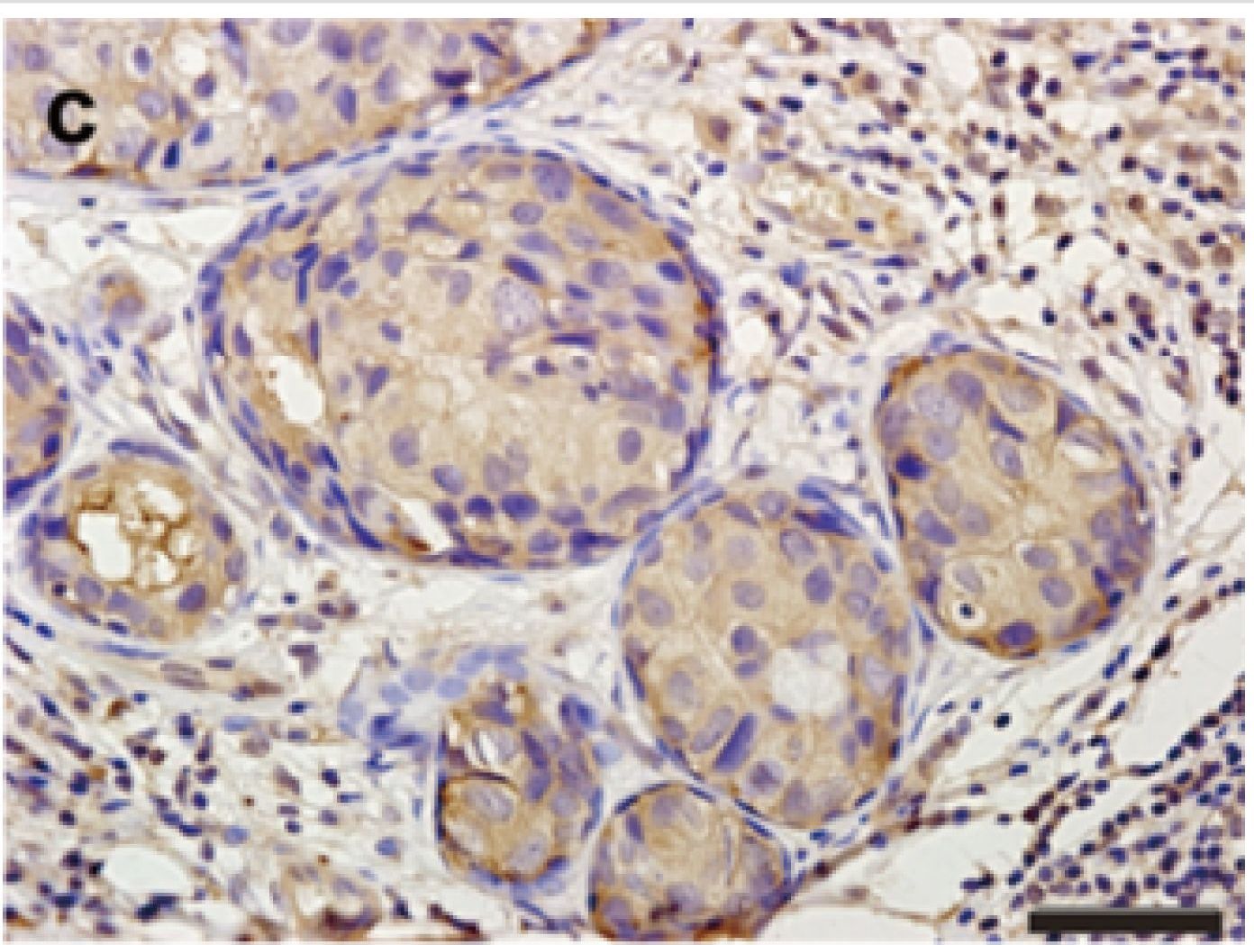 Fig.1.C showing Immunohistochemistry-paraffin in a Homo sapiens (Human) sample from the publication: TMPRSS4 as a poor prognostic factor for triple-negative breast cancer.
