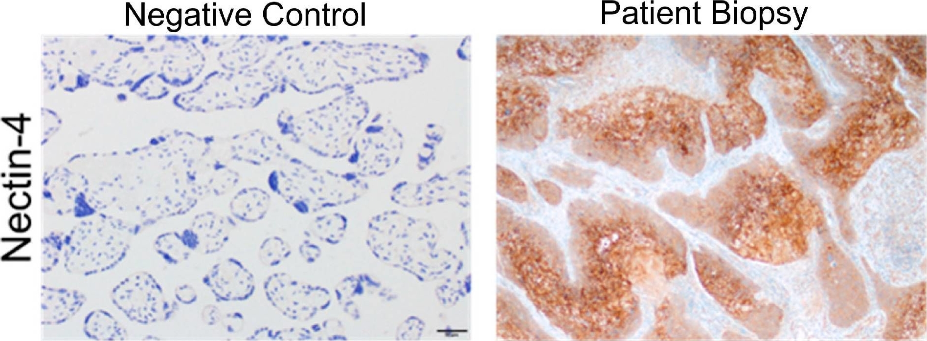 Fig.2.A showing Immunohistochemistry-immunofluorescence in a Homo sapiens (Human) sample from the publication: Metastatic Penile Squamous Cell Carcinoma Responsive to Enfortumab Vedotin.