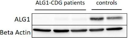 Fig.4.B showing Western Blotting in a Homo sapiens (Human) sample from the publication: Targeted Proteomics Reveals Quantitative Differences in Low-Abundance Glycosyltransferases of Patients with Congenital Disorders of Glycosylation.