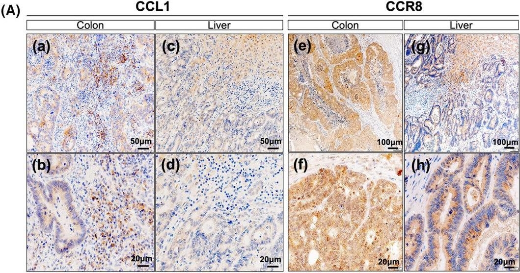 Fig.2.A showing Immunohistochemistry in a Homo sapiens (Human) sample from the publication: Reduced chemokine C-C motif ligand 1 expression may negatively regulate colorectal cancer progression at liver metastatic sites.