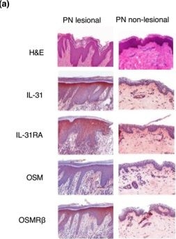 Fig.1.A showing Immunohistochemistry in a Homo sapiens (Human) sample from the publication: Th2 mRNA gene expression analysis separates Prurigo nodularis into two immune signature groups.