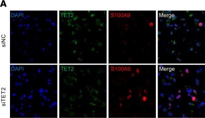 Fig.4.A showing Immunohistochemistry-immunofluorescence from the publication: Clonal hematopoiesis activates procalcific pathways in macrophages and promotes aortic valve stenosis.