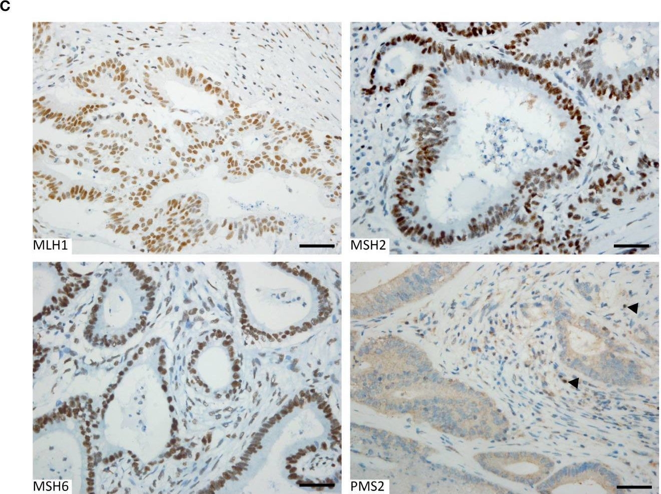 Fig.4.C showing Immunohistochemistry in a Homo sapiens (Human) sample from the publication: Mono- and biallelic germline variants of DNA glycosylase genes in colon adenomatous polyposis families from two continents.