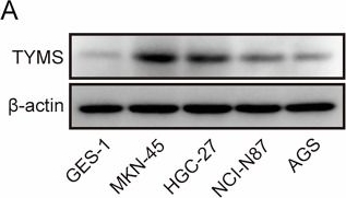 Fig.1.A showing Western Blotting in a Homo sapiens (Human) sample from the publication: Chidamide enhances the sensitivity of gastric cancer to 5-fluorouracil chemotherapy by suppressing the HDAC3/HNF4A/TYMS axis.