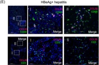 Fig.5.E showing Immunohistochemistry-immunofluorescence in a Homo sapiens (Human) sample from the publication: Cell-type-specific expression analysis of liver transcriptomics with clinical parameters to decipher the cause of intrahepatic inflammation in chronic hepatitis B.