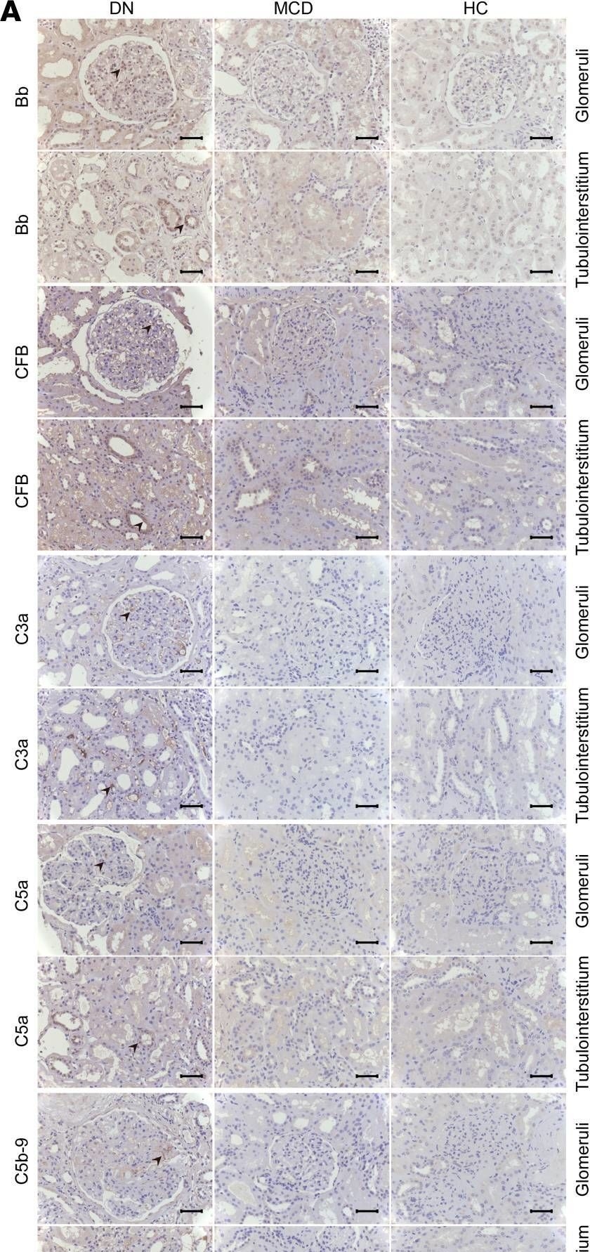 Fig.1.A showing Immunohistochemistry in a Homo sapiens (Human) sample from the publication: Deficiency of CFB attenuates renal tubulointerstitial damage by inhibiting ceramide synthesis in diabetic kidney disease.