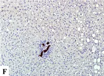 Fig.1.F showing Immunohistochemistry in a Homo sapiens (Human) sample from the publication: Expression of hypoxic marker carbonic anhydrase IX predicts poor prognosis in resectable hepatocellular carcinoma.