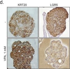 Fig.2.D showing Immunohistochemistry in a Homo sapiens (Human) sample from the publication: Valproic acid improves the efficacy of oxaliplatin/fluoropyrimidine-based chemotherapy by targeting cancer stem cell via β-Catenin modulation in colorectal cancer.