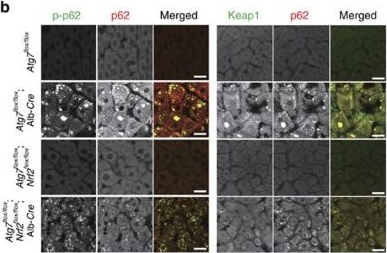 p62/Sqstm1 promotes malignancy of HCV-positive hepatocellular carcinoma through Nrf2-dependent metabolic reprogramming.