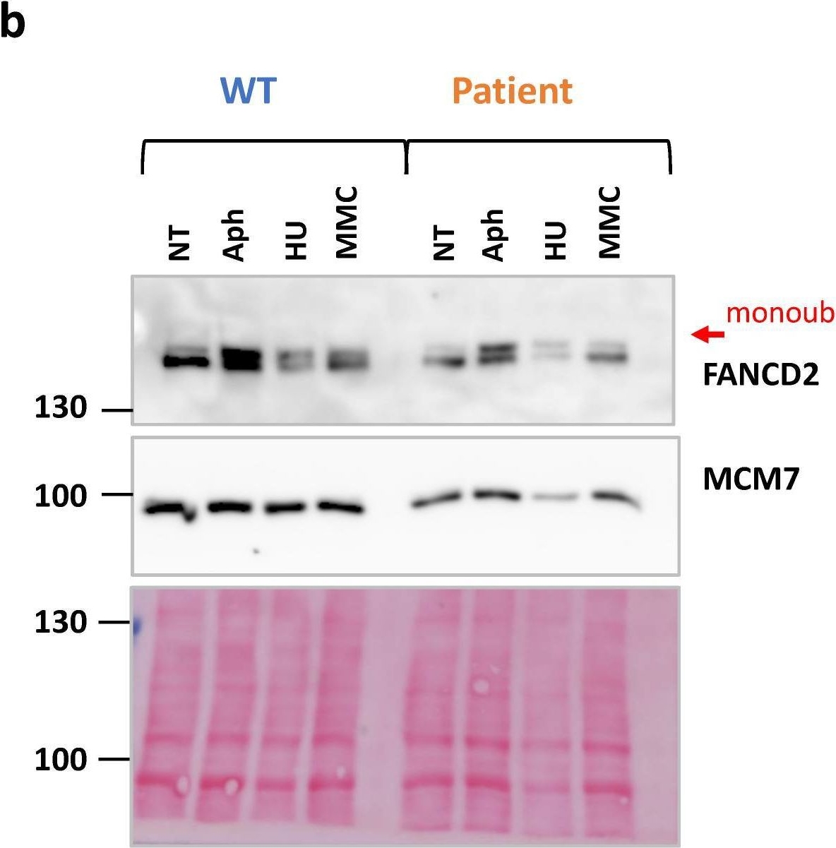 Fig.7.B showing Western Blotting from the publication: Biallelic Germline BRCA1 Frameshift Mutations Associated with Isolated Diminished Ovarian Reserve.