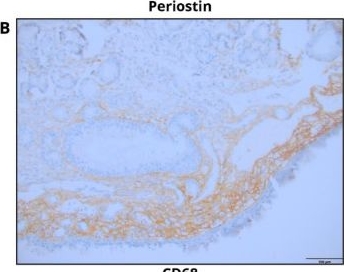 Fig.2.B showing Immunohistochemistry in a Homo sapiens (Human) sample from the publication: Pathway-Specific Effects of Oral Corticosteroids on Eosinophilic Inflammation and Tissue Remodeling in Chronic Rhinosinusitis with Nasal Polyps.