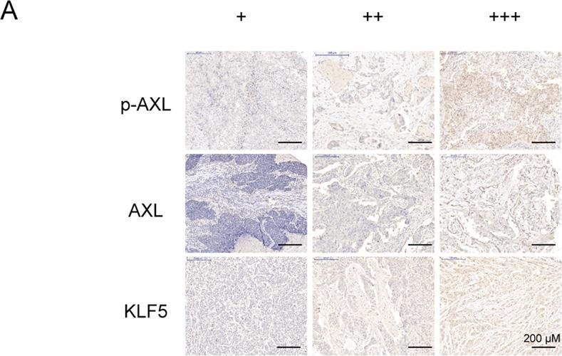 Fig.8.A showing Immunohistochemistry in a Homo sapiens (Human) sample from the publication: Inhibitory effect of the novel tyrosine kinase inhibitor DCC-2036 on triple-negative breast cancer stem cells through AXL-KLF5 positive feedback loop.