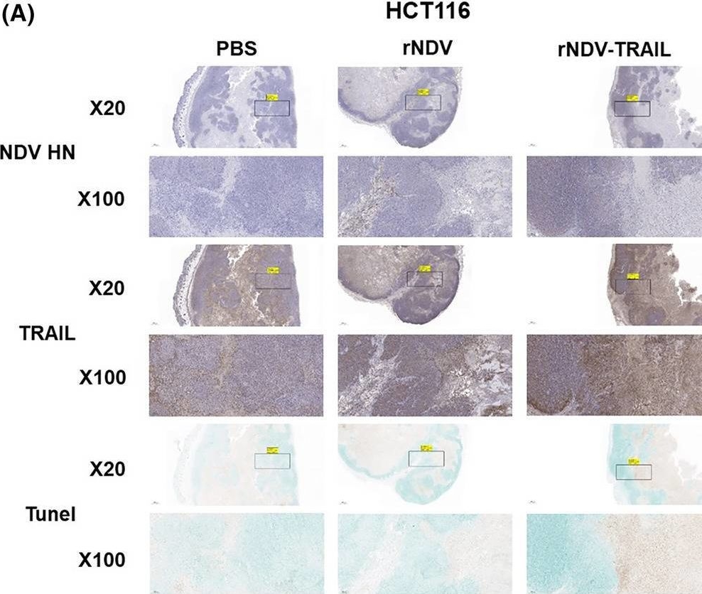 Fig.6.A showing Immunohistochemistry in a Homo sapiens (Human) sample from the publication: The tumor suppressive effect and apoptotic mechanism of TRAIL gene-containing recombinant NDV in TRAIL-resistant colorectal cancer HT-29 cells and TRAIL-nonresistant HCT116 cells, with each cell bearing a mouse model.